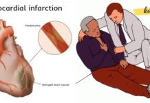 First aid for myocardial infarction — everyone should know this!!