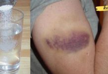 How to Treat Bruises with Table Salt? It’s an Effective Method!