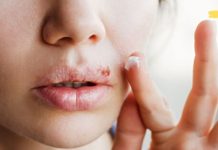 The Best Home Remedies for Treating Herpes (Blister-like Sores). Use if Necessary!