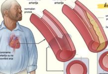 Clean your arteries and prevent a heart attack.